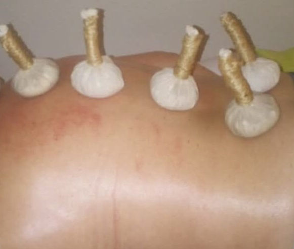 Pindas y Moxabustión